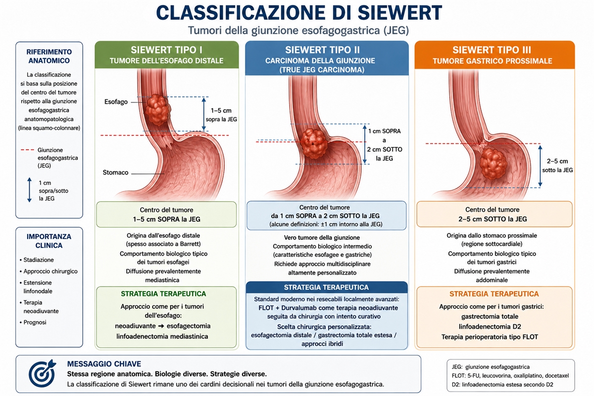 La classificazione di Siewert dei tumori della giunzione esofagogastrica, ancora la più utilizzata!